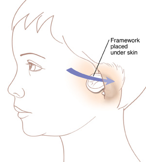 Side view of head showing insertion of the ear cartilage framework placed under the skin at the location of the new ear.