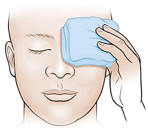 Person holding cold compress on eye.