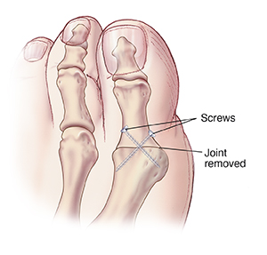 Top view of big toe showing screws holding bones together after joint removed.