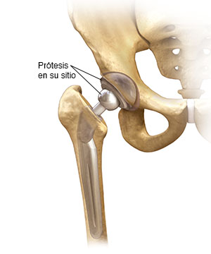 Vista frontal de la articulación de la cadera que muestra una prótesis colocada.