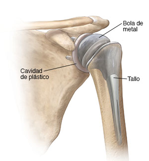 Vista frontal de la articulación del hombro con reemplazo total del hombro.