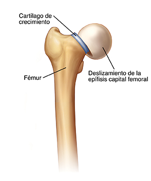 Vista frontal de un fémur en donde se ve la cabeza desplazada de la placa de crecimiento (SCFE).